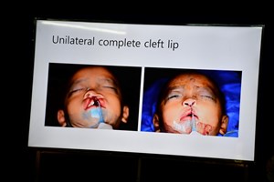 ທີມງານແພດ ສ ເກົາຫຼີ ຜ່າຕັດສົບແວ່ງ ເພດານໂຫວ່, ບາດແຜໄຟໄໝ້ໃຫ້ປະຊາຊົນໂດຍບໍ່ເສຍຄ່າ