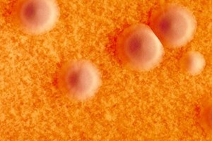 ພະຍາດຄໍຕີບ ເຮັດໃຫ້ປະຊາຊົນໃນກີນີ ເສຍຊີວິດ ຫຼາຍກວ່າ 50 ຄົນ