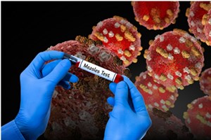 ນີເຊຣີພົບຜູ້ເສຍຊີວິດ 42 ຄົນ ຍ້ອນພະຍາດໝາກແດງ 