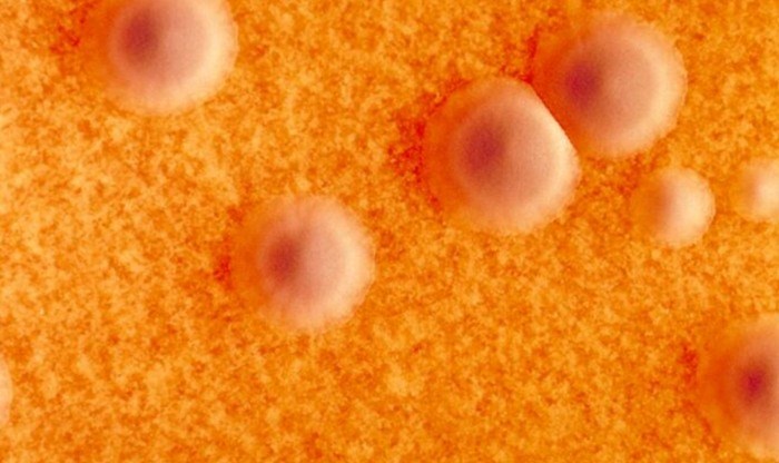 ພະຍາດຄໍຕີບ ເຮັດໃຫ້ປະຊາຊົນໃນກີນີ ເສຍຊີວິດ ຫຼາຍກວ່າ 50 ຄົນ